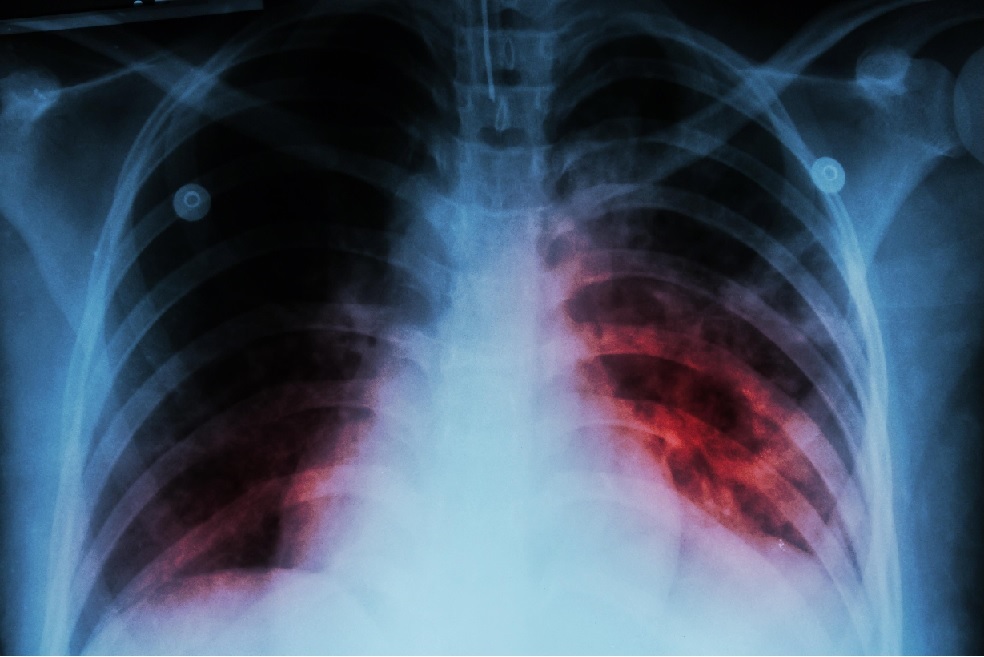 Más de 17 mil casos de tuberculosis fueron registrados en el 2022